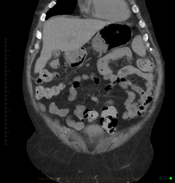 File:Acute renal failure post IV contrast injection- CT findings (Radiopaedia 47815-52557 Coronal non-contrast 9).jpg