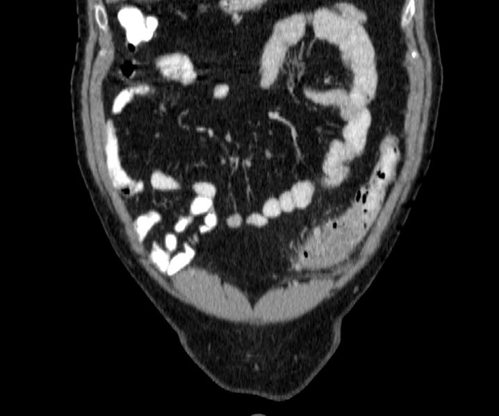 File:Acute sigmoid colon diverticulitis (Radiopaedia 55507-61976 Coronal C+ portal venous phase 19).jpg