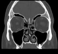 Acute sinusitis (Radiopaedia 23161-23215 Coronal bone window 32).jpg