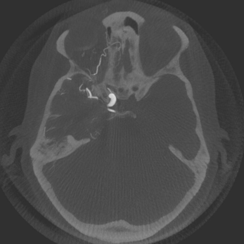 Acute subarachnoid hemorrhage and accessory anterior cerebral artery (Radiopaedia 69231-79010 Axial arterial - MIP 25).jpg
