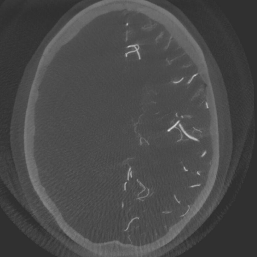 Acute subarachnoid hemorrhage and accessory anterior cerebral artery (Radiopaedia 69231-79010 C 44).jpg