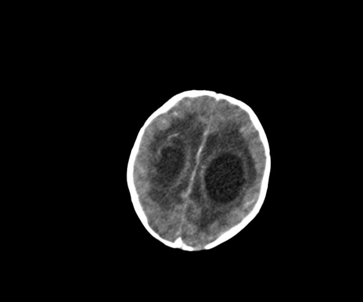 File:Acute ventriculitis (Radiopaedia 57502-64459 Axial +contrast 15).jpg
