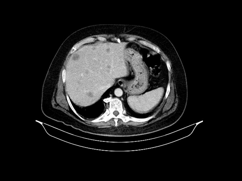 File:Adenocarcinoma of pancreas with hepatic metastasis (Radiopaedia 64332-73122 Axial C+ portal venous phase 21).jpg
