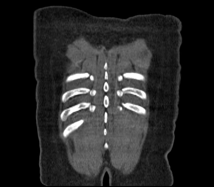 File:Adenocarcinoma of the lung (Radiopaedia 44205-47803 Coronal C+ portal venous phase 95).jpg