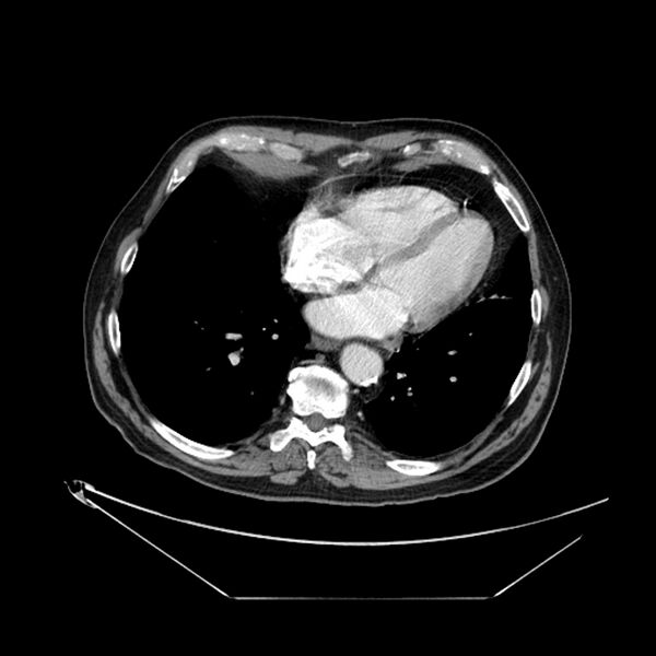 File:Adenocarcinoma of the lung (Radiopaedia 44876-48759 Axial C+ portal venous phase 59).jpg