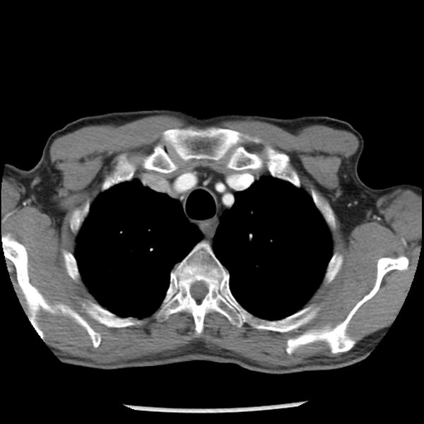 File:Adenocarcinoma of the lung - micropapillary predominant (Radiopaedia 42446-45563 Axial C+ portal venous phase 12).jpg