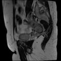 Adenomyosis and endometriotic cysts (Radiopaedia 82300-96367 Sagittal T2 28).jpg