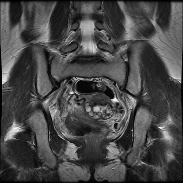 File:Adenomyosis on MRI (Radiopaedia 29328-29780 Coronal T2 5).jpg