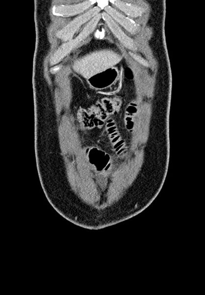 File:Adhesional small bowel obstruction (Radiopaedia 58900-66131 Coronal C+ portal venous phase 65).jpg