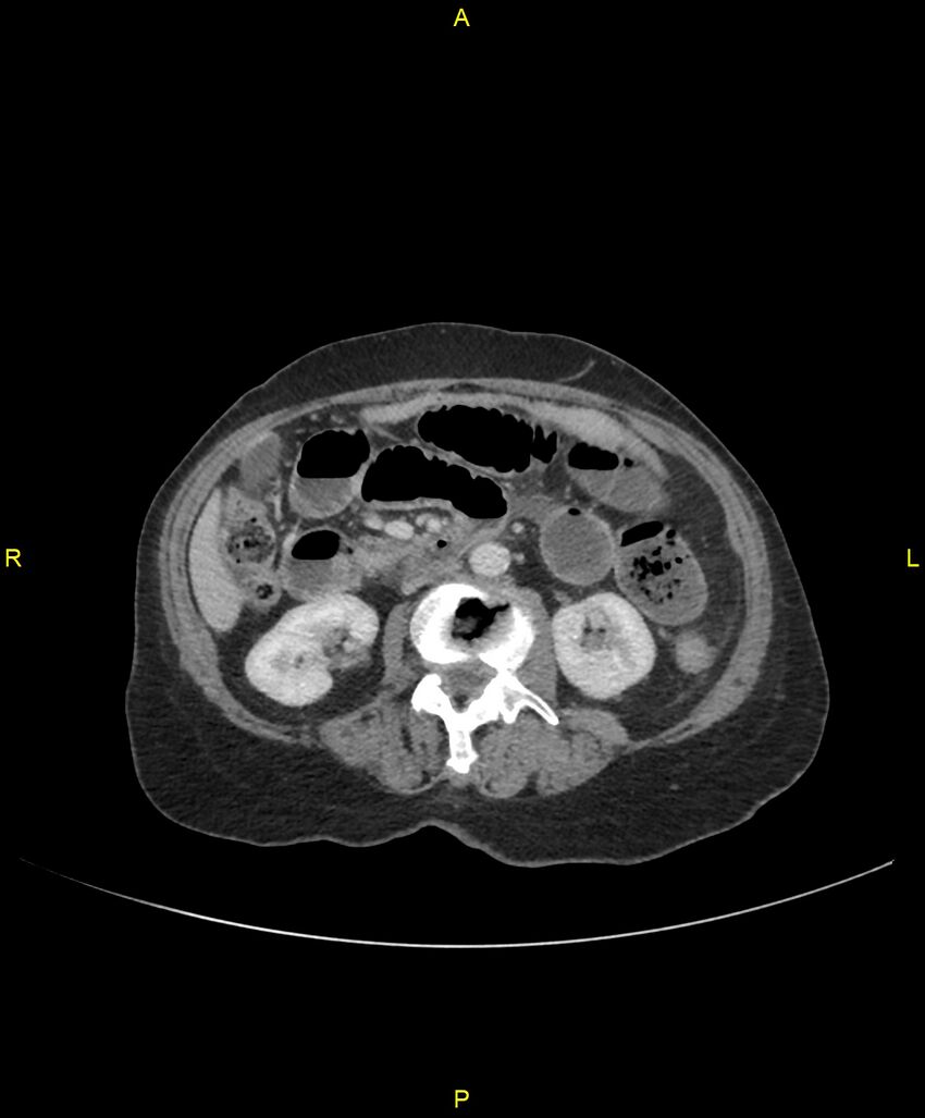 Adhesional small bowel obstruction (Radiopaedia 85402-101024 Axial C+ portal venous phase 126).jpg