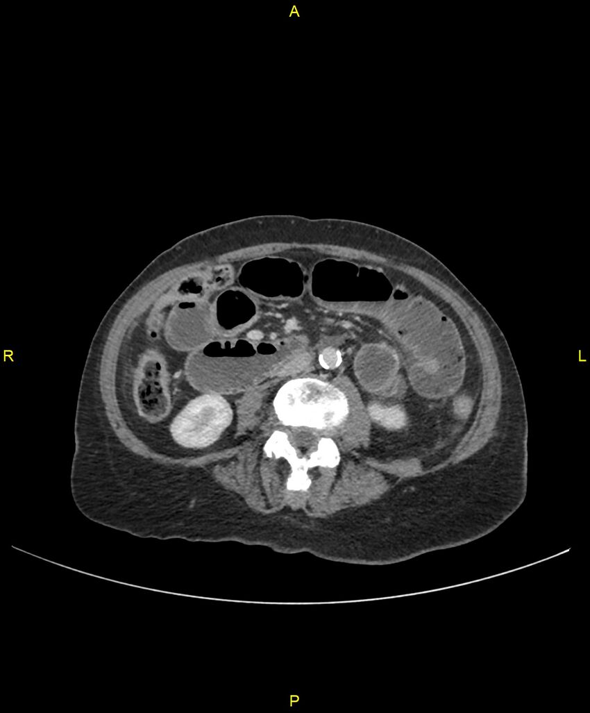 Adhesional small bowel obstruction (Radiopaedia 85402-101024 Axial C+ portal venous phase 147).jpg