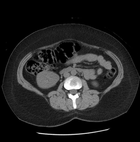 File:Adrenal cortical carcinoma with IVC invasion and thrombosis (Radiopaedia 34307-35597 Axial non-contrast 32).jpg