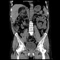 Adrenal myelolipoma (Radiopaedia 41843-44834 Coronal non-contrast 6).jpg