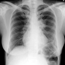Chest X-ray: mass overlying the left hilum