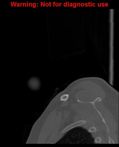 File:Ameloblastoma (Radiopaedia 33126-34164 Sagittal bone window 5).jpg