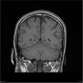 Amnestic syndrome secondary to hypoxic brain injury (Radiopaedia 24743-25004 B 8).jpg