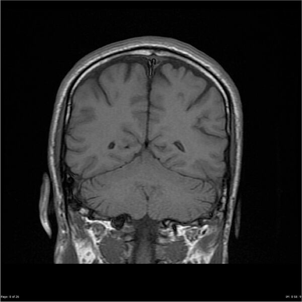 File:Amnestic syndrome secondary to hypoxic brain injury (Radiopaedia 24743-25004 B 8).jpg
