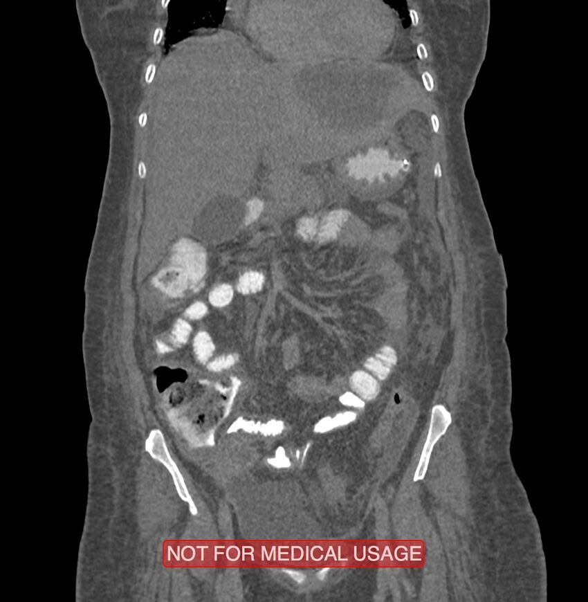 Amoebic enterocolitis with liver abscess (Radiopaedia 35100-36609 B 65).jpg