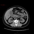 Ampullary carcinoma (Radiopaedia 56396-63056 Axial non-contrast 23).jpg