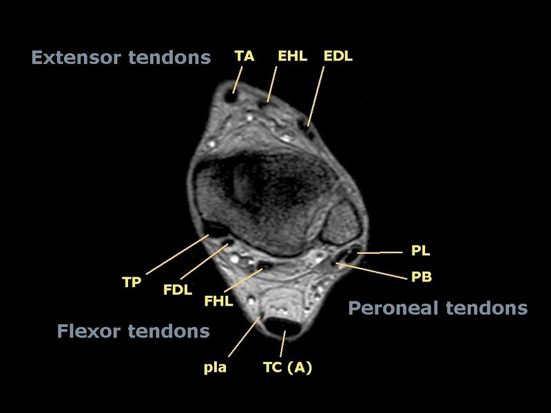 File:Ankle tendons- topographic anatomy (Radiopaedia 14238).jpg