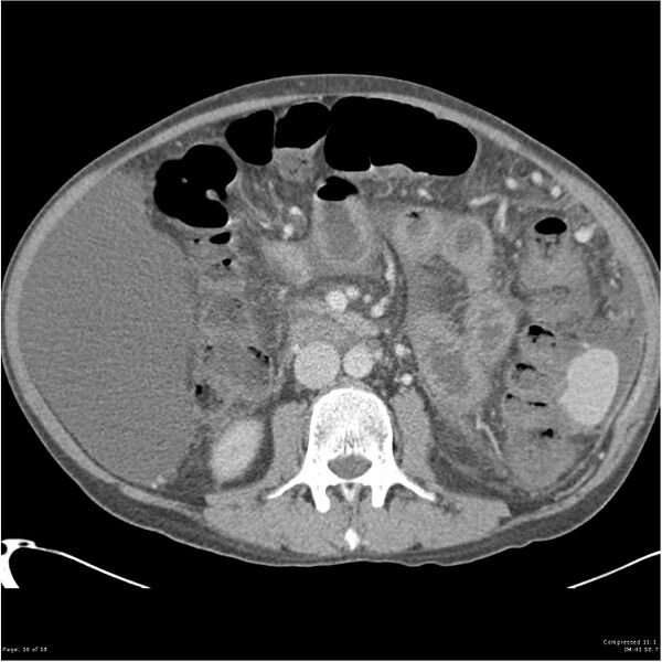 File:Annular pancreas and cirrhosis (Radiopaedia 24561-24843 A 16).jpg