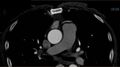 Anomalous left coronary artery- prepulmonic course (Radiopaedia 29253-29667 A 2).JPG