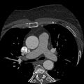 Anomalous origin of left circumflex artery from right coronary sinus (Radiopaedia 72563-83117 B 9).jpg