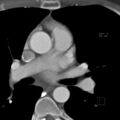 Anomalous right coronary artery (ARCA) with interarterial course (Radiopaedia 12423-12677 B 8).jpg