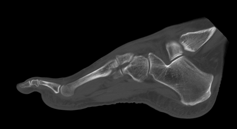 File:Anterior calcaneal process fracture (Radiopaedia 47384-51989 Sagittal bone window 13).png