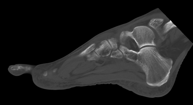 File:Anterior calcaneal process fracture (Radiopaedia 47384-51989 Sagittal bone window 16).png