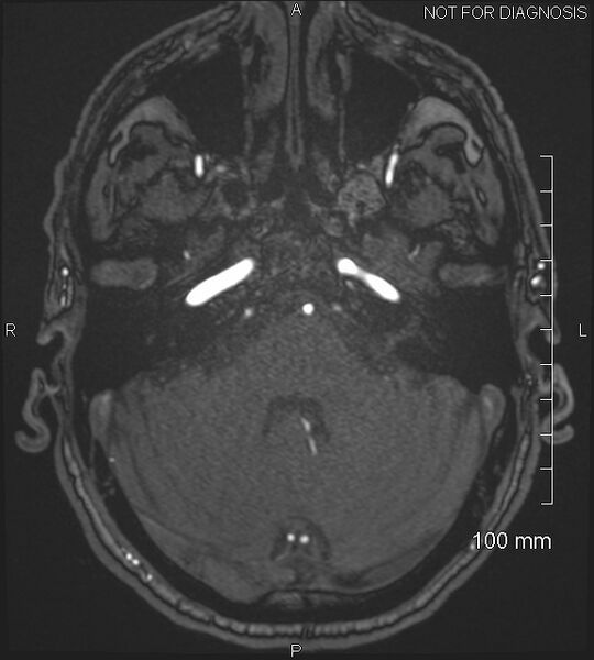 File:Anterior cerebral artery aneurysm (Radiopaedia 80683-94127 Axial MRA 52).jpg