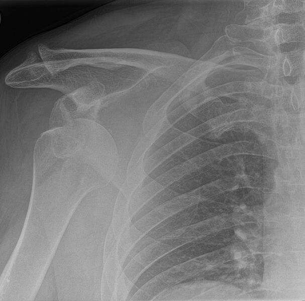 File:Anterior glenohumeral dislocation with Hill-Sachs lesion (Radiopaedia 62877-71250 Frontal 1).JPG
