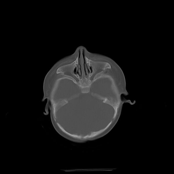File:Anterior plagiocephaly (Radiopaedia 71836-82273 Axial bone window 4).jpg