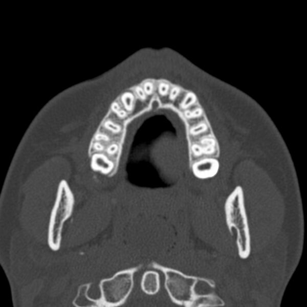 File:Antrochoanal polyp (Radiopaedia 21894-21868 Axial bone window 5).jpg