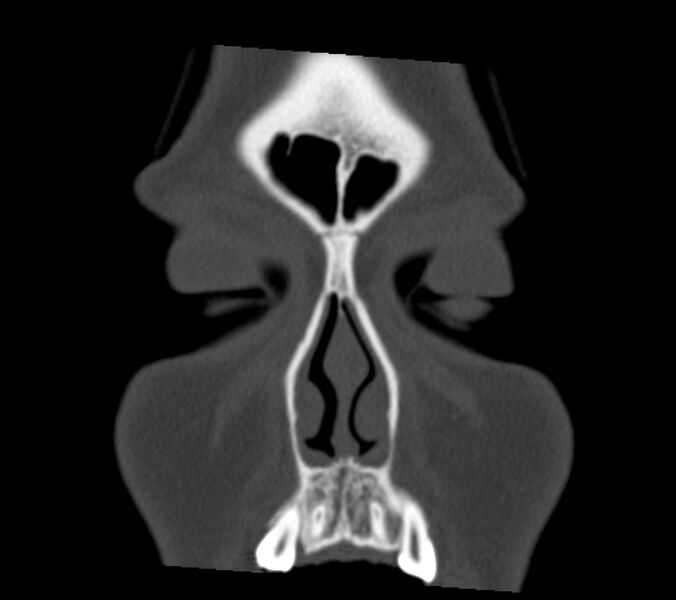 File:Antrochoanal polyp (Radiopaedia 21894-21868 Coronal bone window 2).jpg