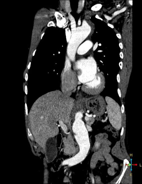 File:Aortic aneurysm and penetrating ulcer (Radiopaedia 23590-23704 B 3).jpg