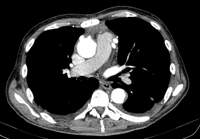 File:Aortic arch saccular aneurysm (Radiopaedia 19430-19457 B 20).jpg