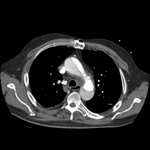 File:Aortic dissection with rupture into pericardium (Radiopaedia 12384-12647 A 19).jpg