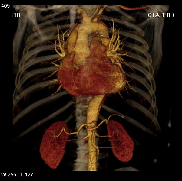 File:Aortic dissection with rupture into pericardium (Radiopaedia 12384-12647 C+ arterial phase 37).jpg