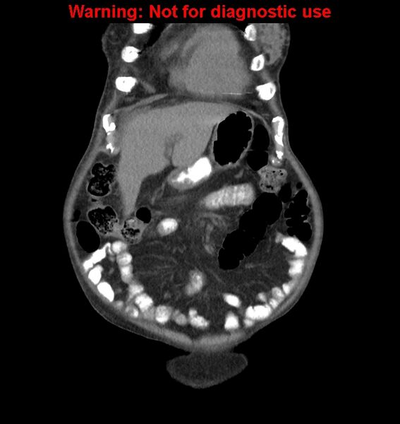 File:Aortic graft infection (Radiopaedia 44979-48907 non-contrast 10).jpg