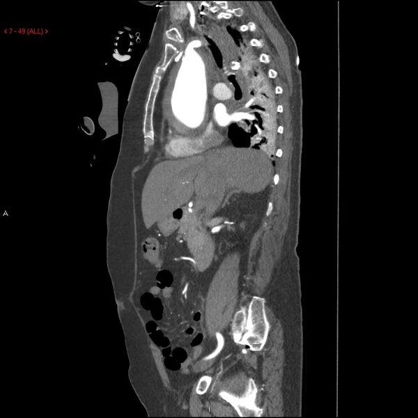 File:Aortic intramural hematoma (Radiopaedia 27746-28001 C 18).jpg