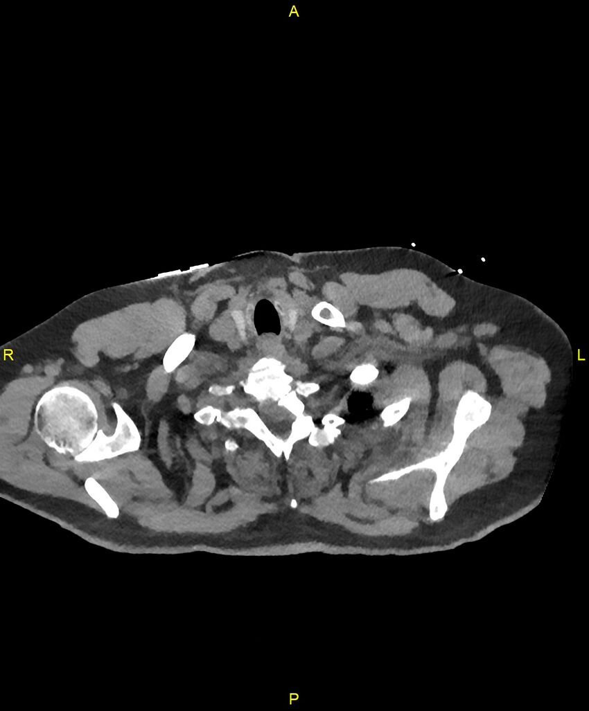 Aortic rupture (Radiopaedia 88822-105594 Axial non-contrast 1).jpg