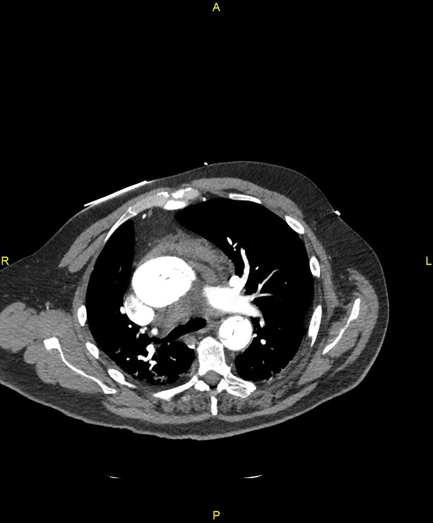 Aortic rupture (Radiopaedia 88822-105594 B 91).jpg