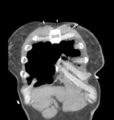 Aortic valve non-coronary cusp thrombus (Radiopaedia 55661-62189 C 12).png
