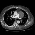 Aorto-coronary bypass graft aneurysms (Radiopaedia 40562-43157 A 48).png