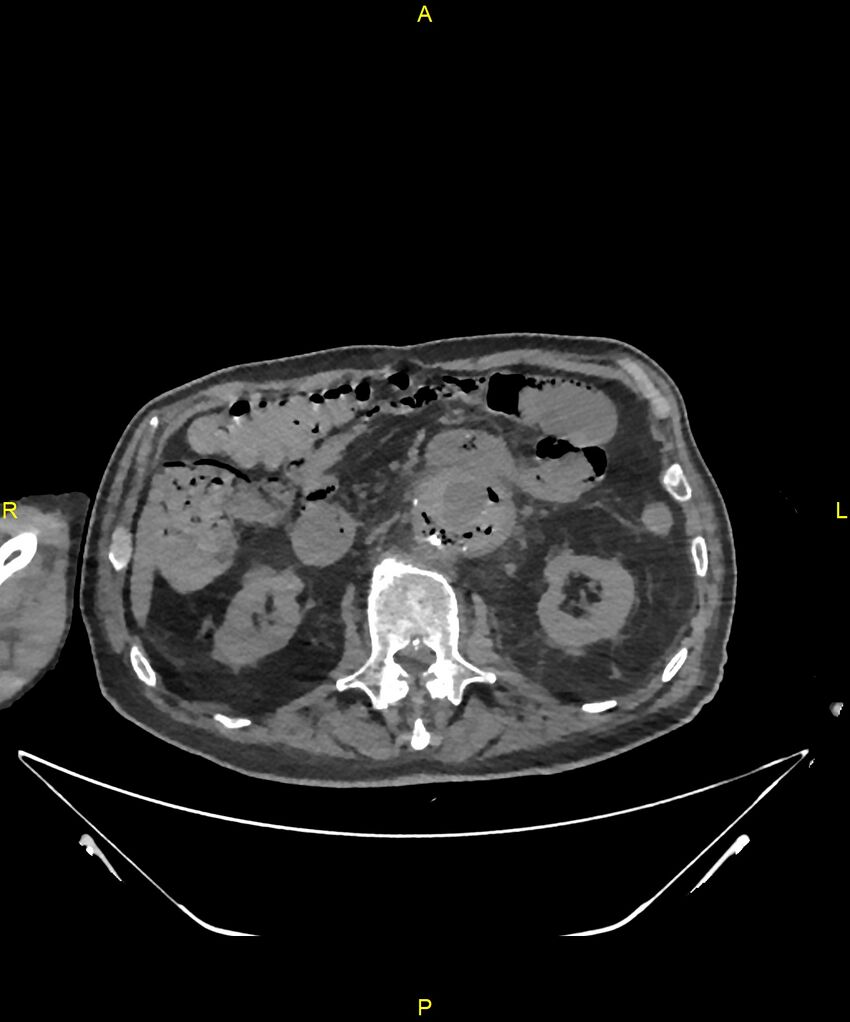 Aortoenteric fistula (Radiopaedia 84308-99603 Axial non-contrast 139).jpg