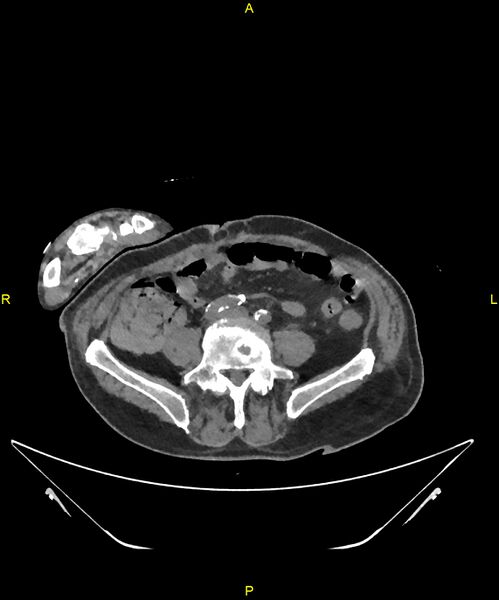 File:Aortoenteric fistula (Radiopaedia 84308-99603 Axial non-contrast 245).jpg