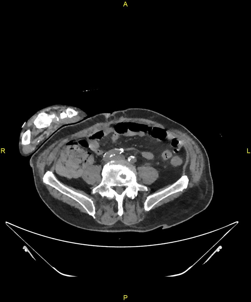 Aortoenteric fistula (Radiopaedia 84308-99603 Axial non-contrast 245).jpg
