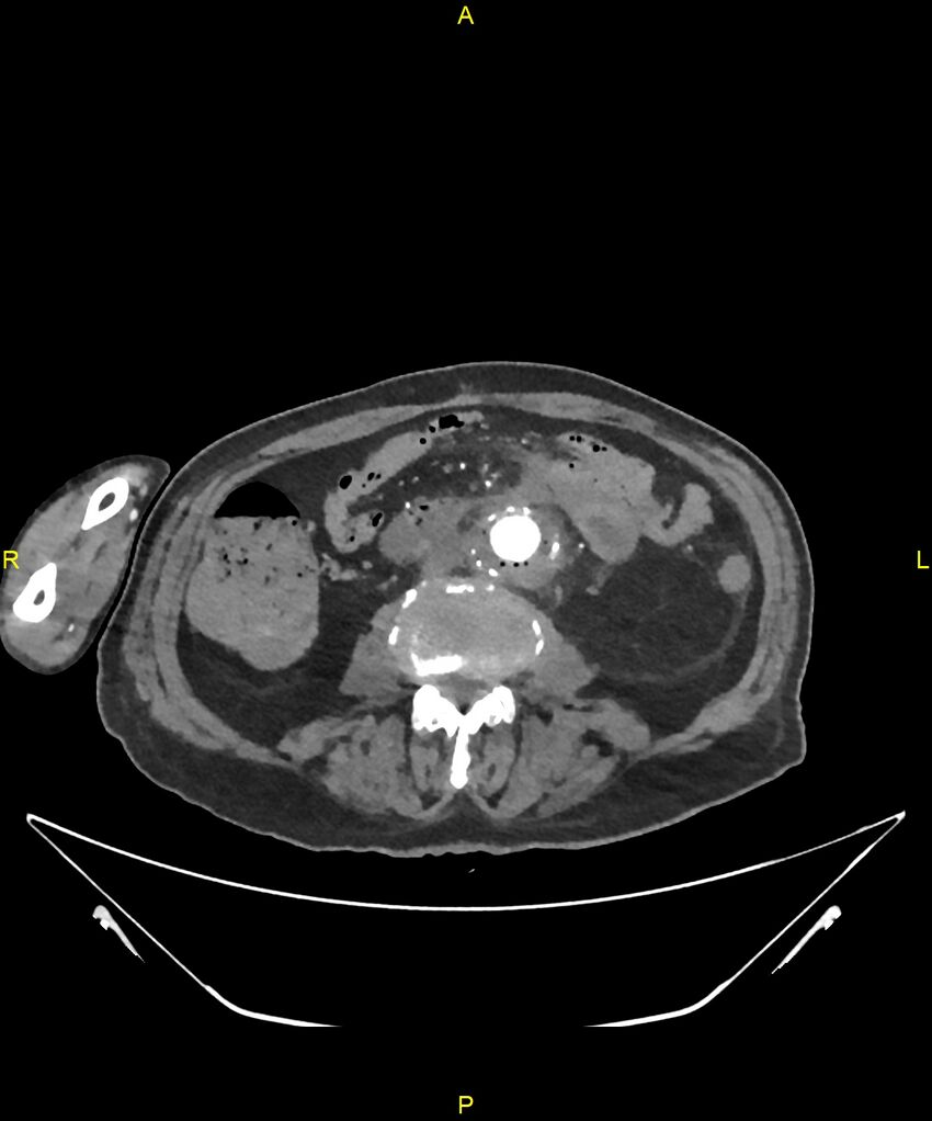 Aortoenteric fistula (Radiopaedia 84308-99603 B 201).jpg