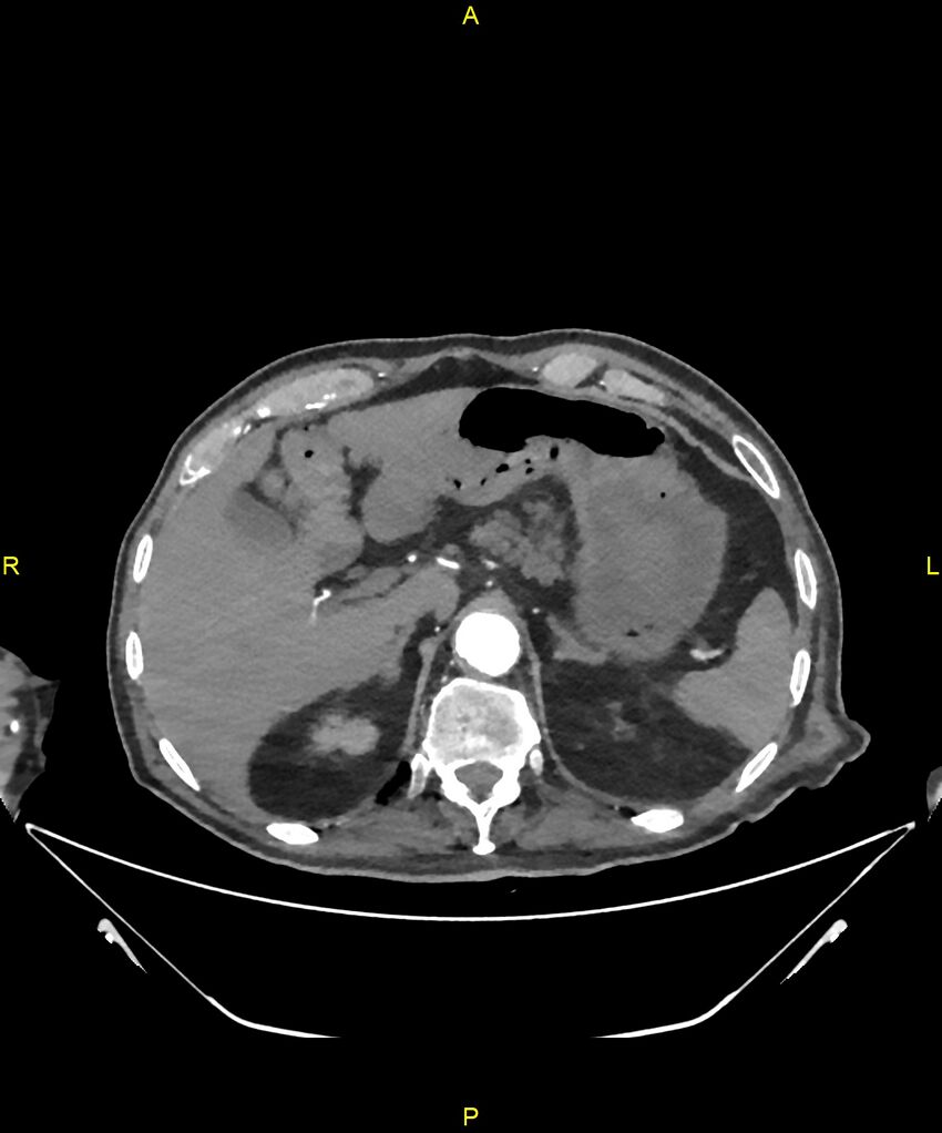 Aortoenteric fistula (Radiopaedia 84308-99603 B 65).jpg